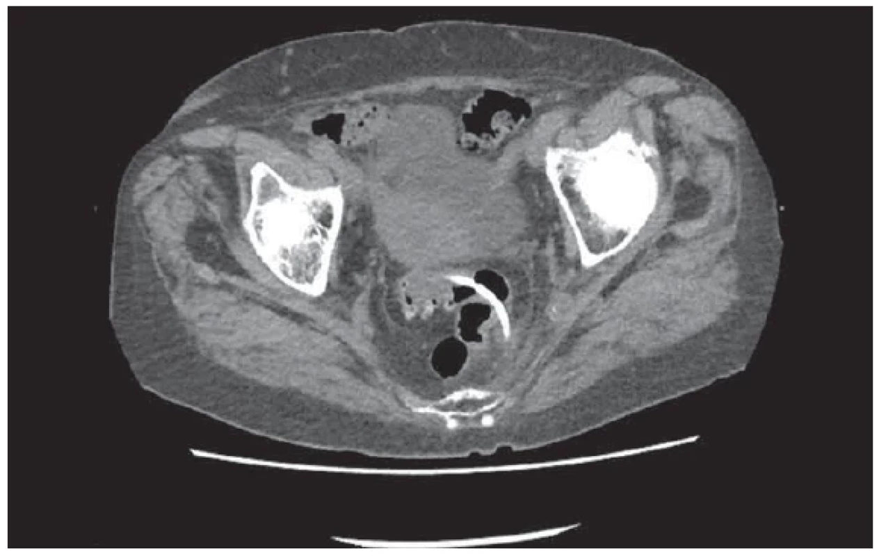 CT malé pánve: perforace sigmatu DB stentem. <br> 
Fig. 3. CT of small pelvis: perforation of sigmoid DB by a stent.