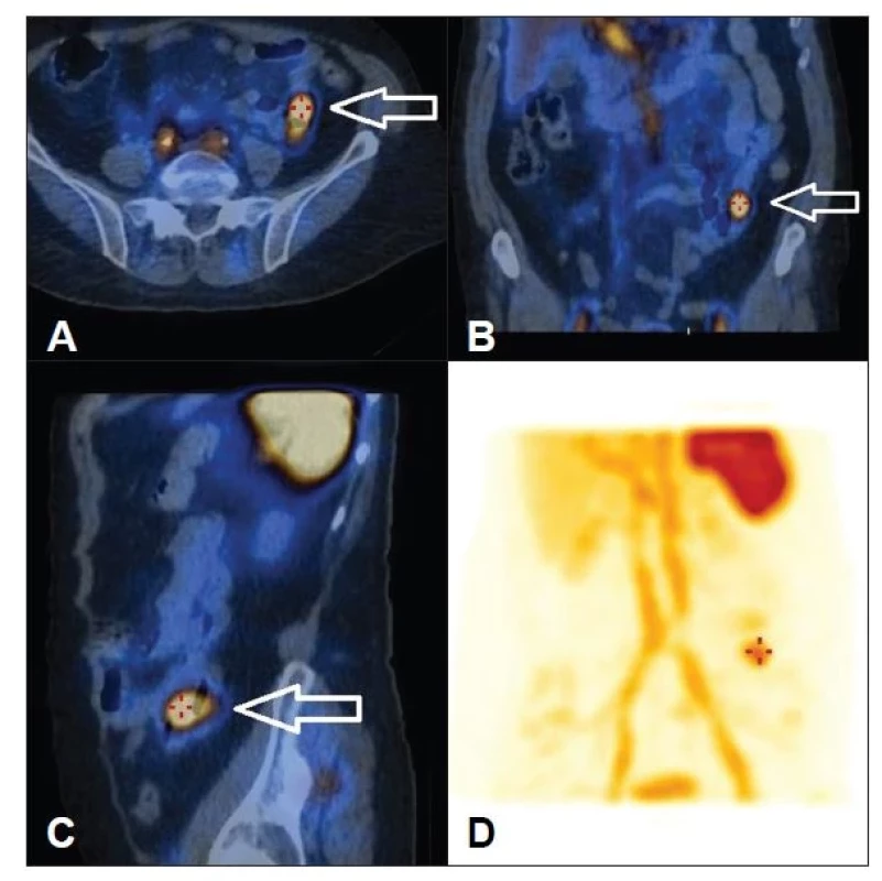 SPECT/ldCT obraz se záchytem extravazátu v oblasti distálního jejuna.
Uspořádání obrazů jako na Obr. 4.