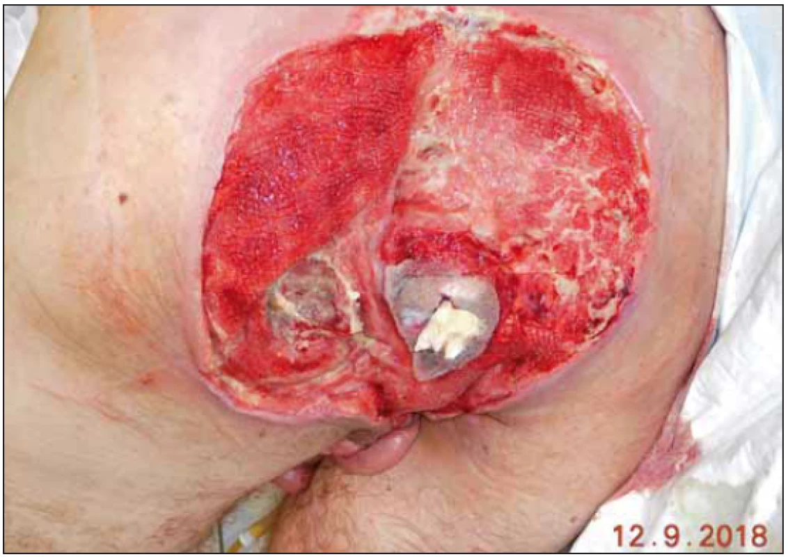 Stav po odstranění podtlakového systému.<br>
Fig. 8. Status after removal of negative pressure wound therapy.