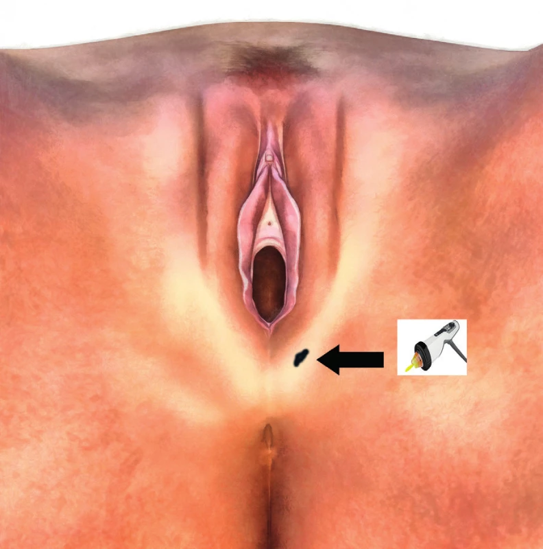 Application area of ESWT