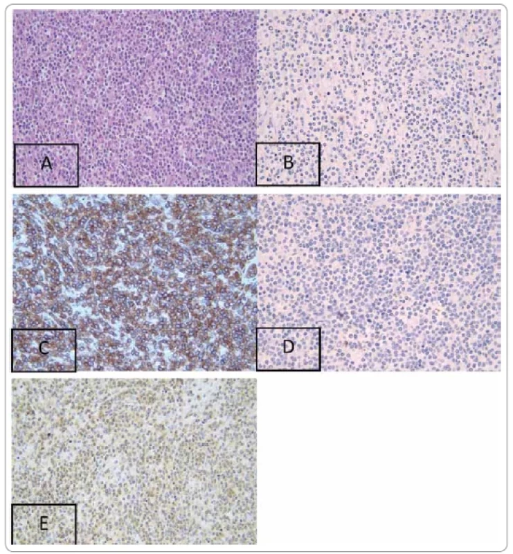 (A) Spleen tissue showed monotonous lymphocytes with medium-size nuclei arranged diff usely with hematoxylin-eosin staining
(400×). (B) Immunohistochemistry examination of T-cell receptor (TCR) beta showed negative results (400×). (C) T-cell receptor
(TCR) gamma positive (400×). (D) Negative T-cell lymphoma protein-1 (TCL-1) (400×). (E) CD3 positive (400×).