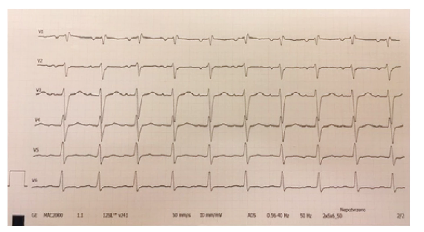 Změny repolarizační fáze – oploštělé až negativní
vlny T – hrudní svody, zdroj vlastní