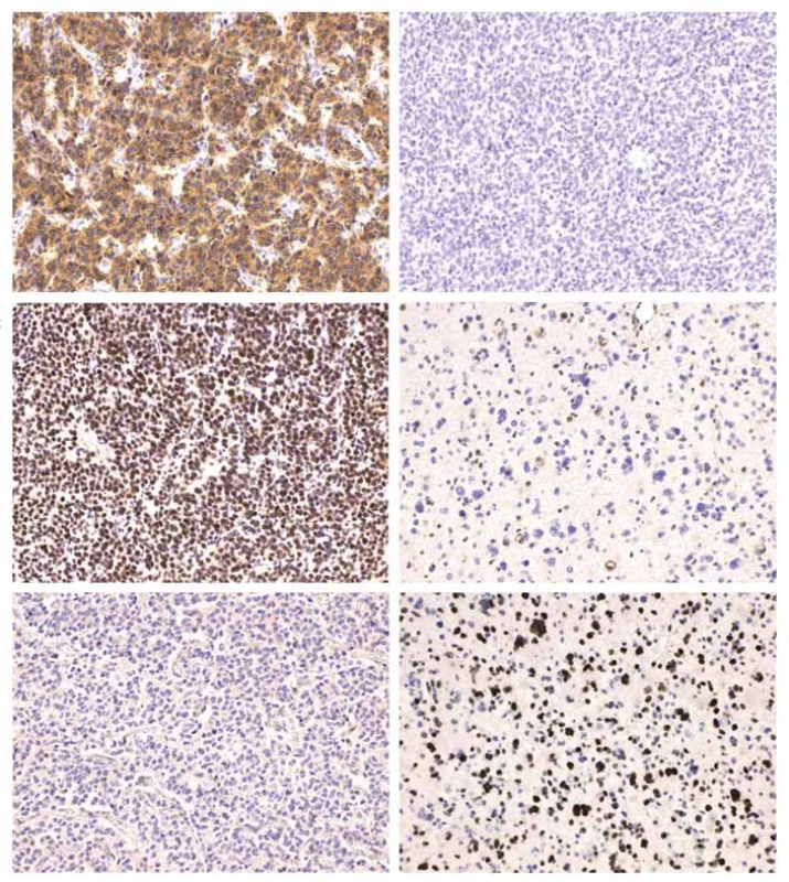 Imunohistochemické vyšetření exprese IDH1-R132H, ATRX a p53.<br>
A) Pozitivní reakce prokazující mutaci R132H genu IDH1.<br>
B) Negativní reakce vylučující mutaci R132H genu IDH1.<br>
C) Wildtype nukleární exprese ATRX.<br>
D) Ztráta nukleární exprese ATRX v jádrech nádorových buněk při zachované nukleární expresi v nenádorových buňkách – průkaz mutace
genu ATRX.<br>
E) Wildtype nukleární exprese p53.<br>
F) Akumulace mutovaného proteinu p53 intranukleárně.<br>
A–F) Původní zvětšení 200×