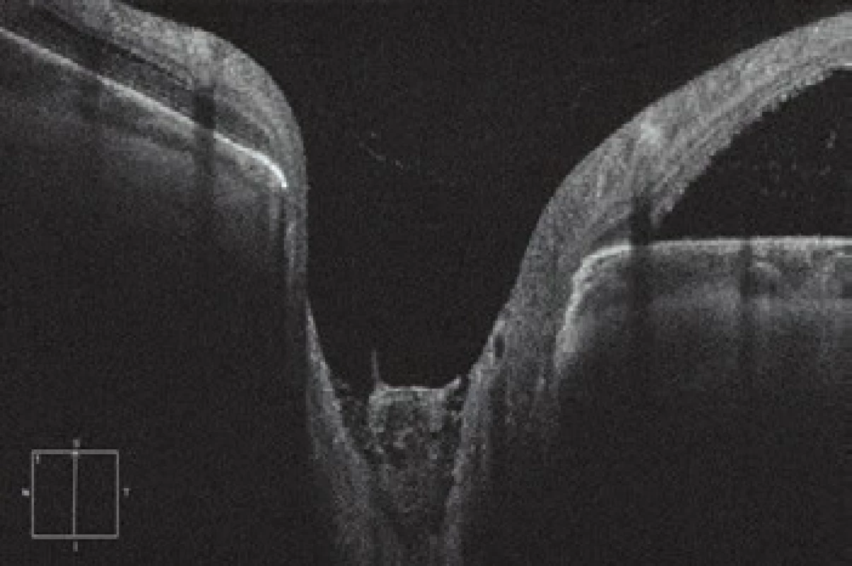 HD-OCT: Linear vertical transpapillary scan of left
eye, extensive ODP covered by medium reflective tissue.
At the upper edge connecting serous ablation of the neuroretina,
with accumulation of fluid sub-retinally