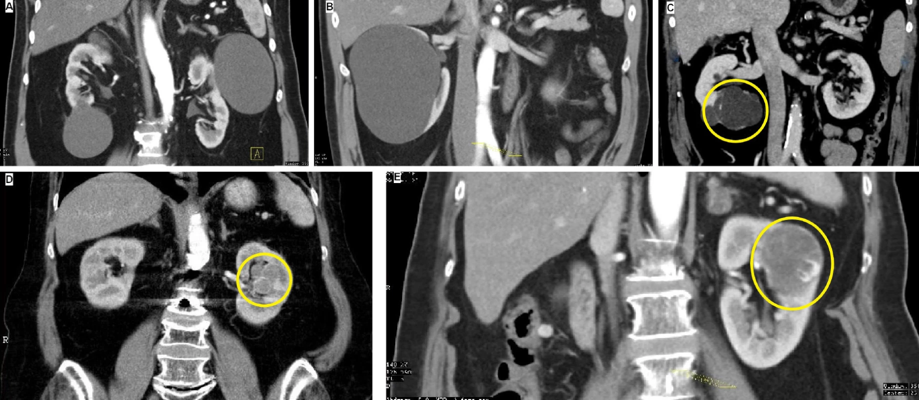 Kategorie dle Bosniaka na CT vyšetření (A – Bosniak I, B – Bosniak II, C – Bosniak IIF, D – Bosniak III, E – Bosniak IV)<br>
Fig. 1. Bosniak categories according to CT imaging (A – Bosniak I, B – Bosniak II, C – Bosniak IIF, D – Bosniak III, E –
Bosniak IV)