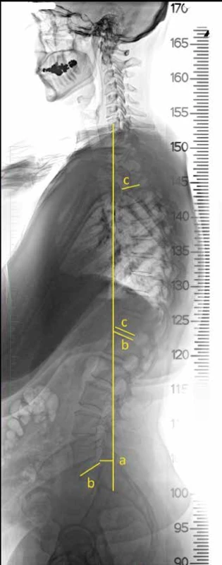 6: Parametry celkové osy páteře
a) C7-S SVA, b) lumbální lordóza dle Cobba, c) hrudní kyfóza
dle Cobba<br>
Fig. 6: Global sagittal spine parameters
a) C7-S SVA; b) lumbar lordosis Cobb angle; c) thoracic kyphosis
Cobb angle