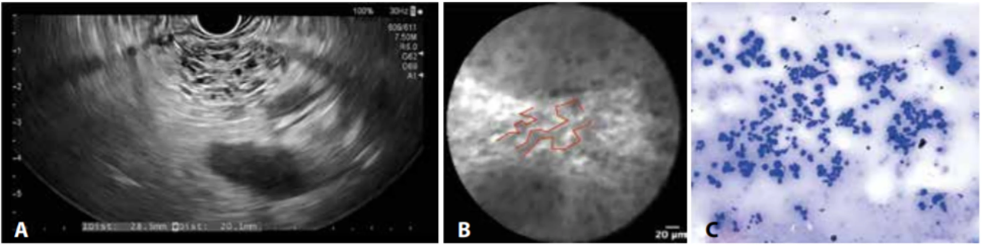 EUS (A), nCLE (B) a cytologický (C) obraz serózního cystadenomu
nCLE s typickým nálezem „povrchové cévní sítě“.<br>
Fig. 4: EUS (A), nCLE (B) and cytology (C) of serous cystadenoma
nCLE with a typical „superficial vascular network pattern“.