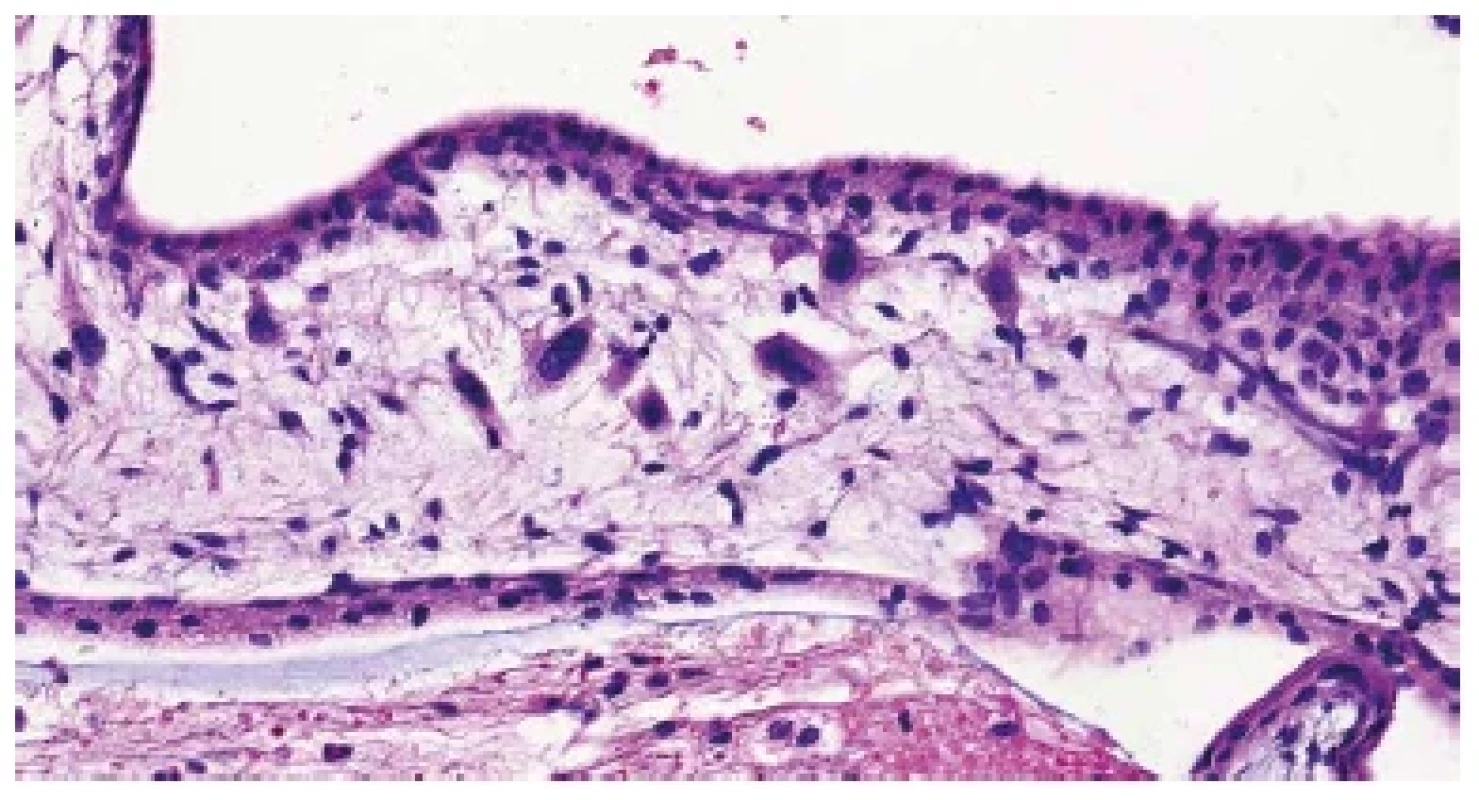 Trizomie chromozomu 18. Buňky s abnormálně velkými jádry ve stromatu
choriového klku (HE, 400x).
