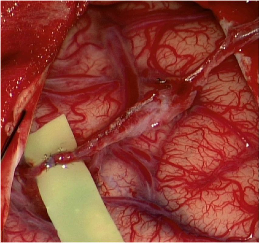 (a) Low-flow end-to-side bypass parietální větve a. temporalis spf. na temporální větev M4 vpravo. Technika jednotlivých stehů; (b) funkční bypass; (c) odstranění arachnoidey nad kortikálními tepnami před našitím temporálního svalu.<br>
Fig. 3. (a) Low-flow end-to-side bypass STA(p)-M4(t). Interrupted suture technique; (b) functioning bypass; (c) arachnoidea cut over cortical arteries before temporalis muscle placement.
