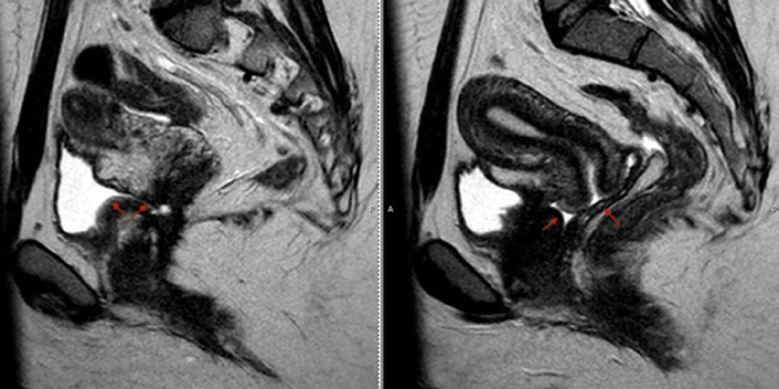 MRI pánve v sagitální projekci přehledně prokazuje přítomnost vezikovaginální píštěle a moči v pochvě (šipky)<br>
Fig. 5. Sagittal view of pelvic MRI demonstrating vesicovaginal fistula and the presence of urine in the vagina (arrows)