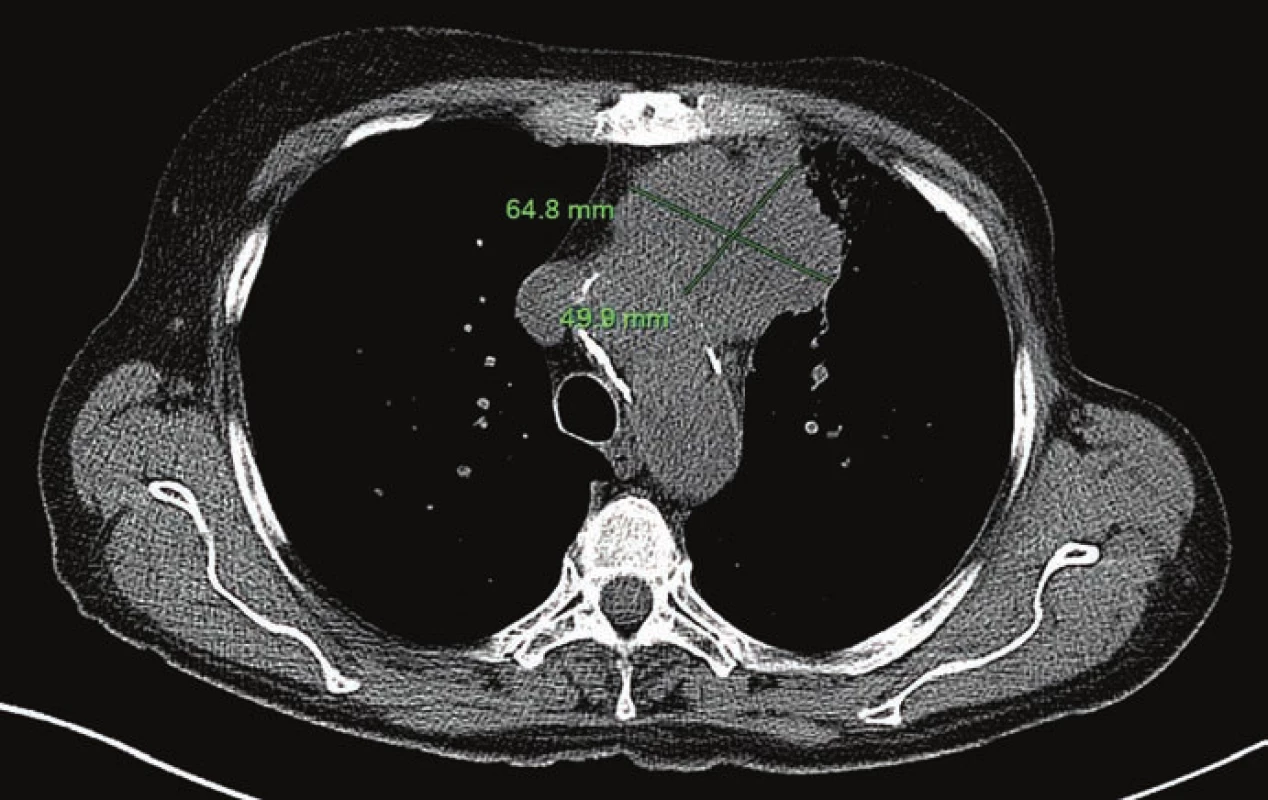 Primární tumor před zahájením onkologické terapie (16. 5. 2013).