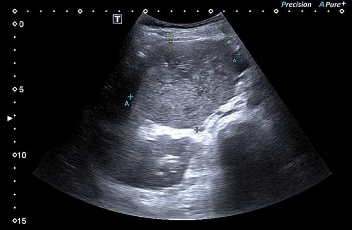 Ultrasonografi cký obraz nitro břišní expanze