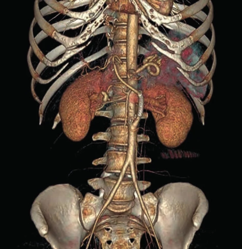 CTA s patentným bypassom 2 mesiace po trombolytickej
liečbe<br>
Fig. 4: CT Angiogram shows patent bypass graft 2 months
after thrombolytic therapy