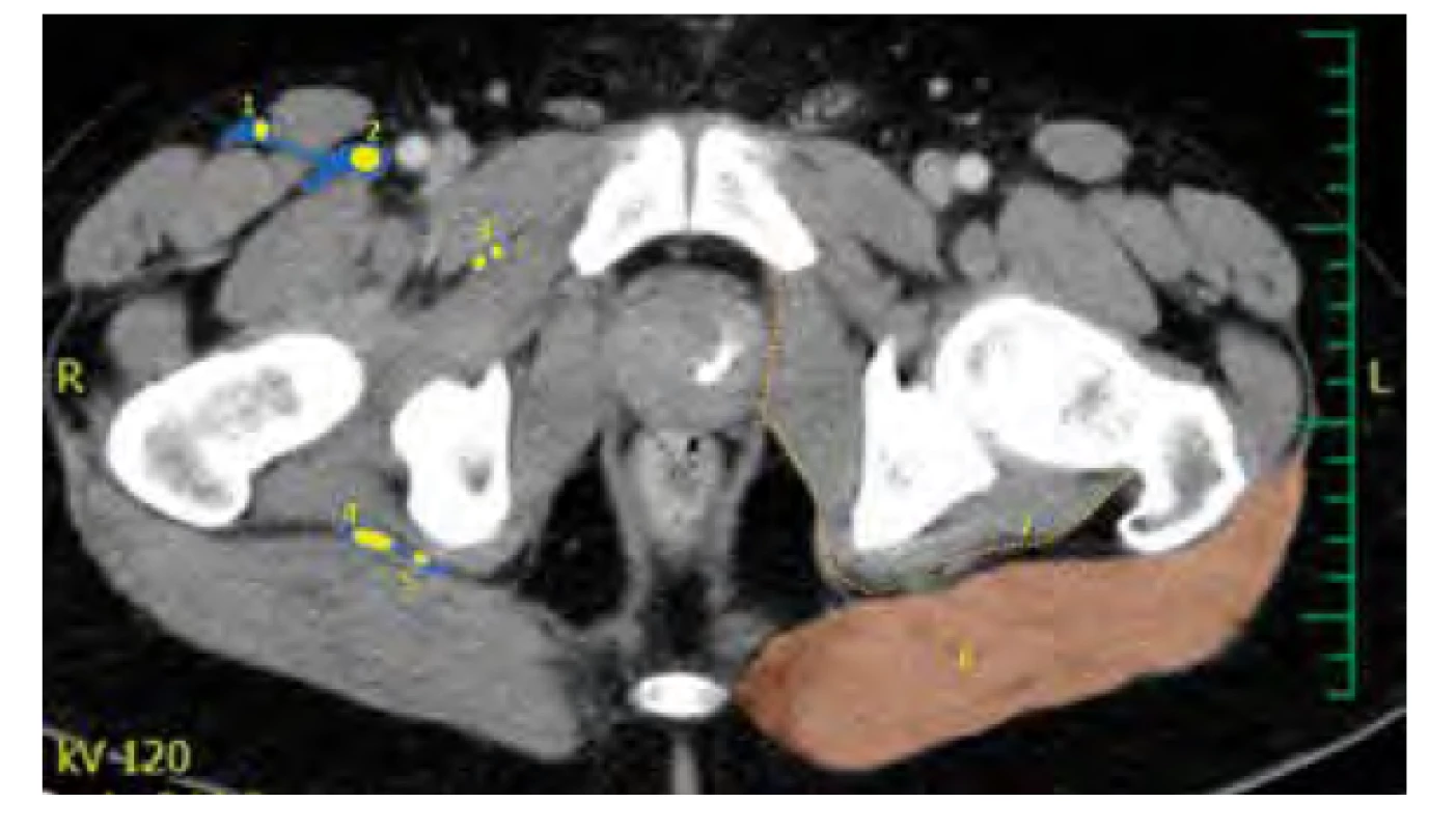 CT obraz: horizontální řez pánví. 1. n. cutaneus femoris lateralis,
2. n. femoralis, 3. n. obturatorius, 4. n. ischiadicus, 5. n. cutaneus femoris dorsalis,
6. m. gluteus maximus, 7. hluboká gluteální fascie. Modrou barvou je naznačen
pravděpodobný distribuční prostor podaného roztoku LA