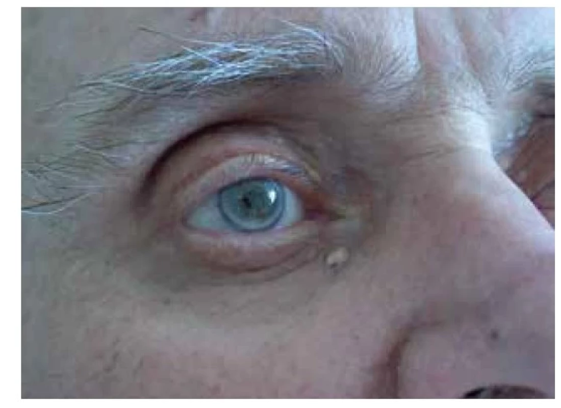 Arcus lipoides cornae (gerontoxon) a xanthelasma
palpebrarum