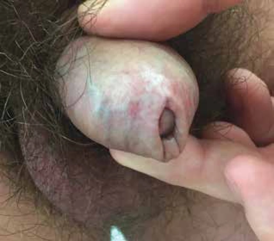 Lichen sclerosus
