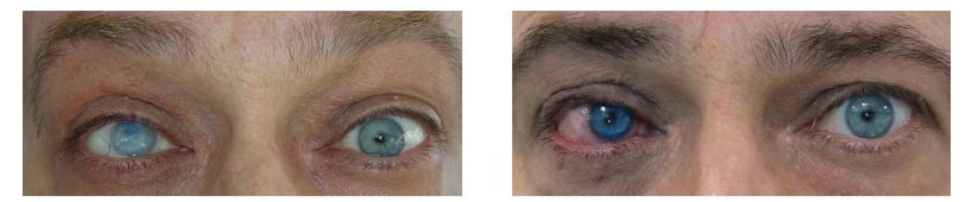 Fig. 6 and 7. Patient no. 3 before and after KTP procedure