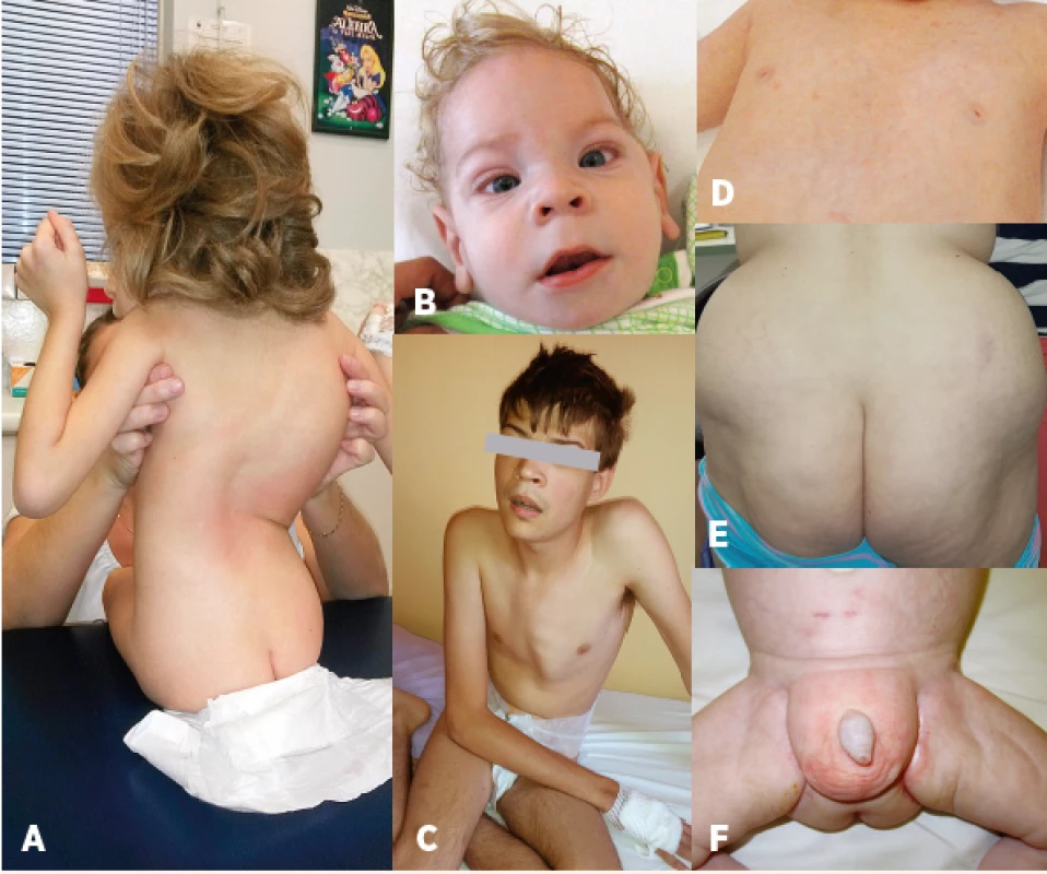 Charakteristický fenotyp: A – kostní deformity – skolióza, B – kraniofaciální
dysmorfie, strabismus, C – pectus carinatum, D – vpáčené bradavky,
E – atypická distribuce tuku v oblasti hýždí, F – atypická distribuce
tuku v oblasti genitálu.<br>
Fig. 2. Characteristic phenotype: A – bone deformities – scoliosis, B – craniofacial
dysmorphism, strabismus, C – pectus carinatum, D – nipples inversion,
E – atypical supragluteal fat distribution, F – atypical perigenital fat
distribution.