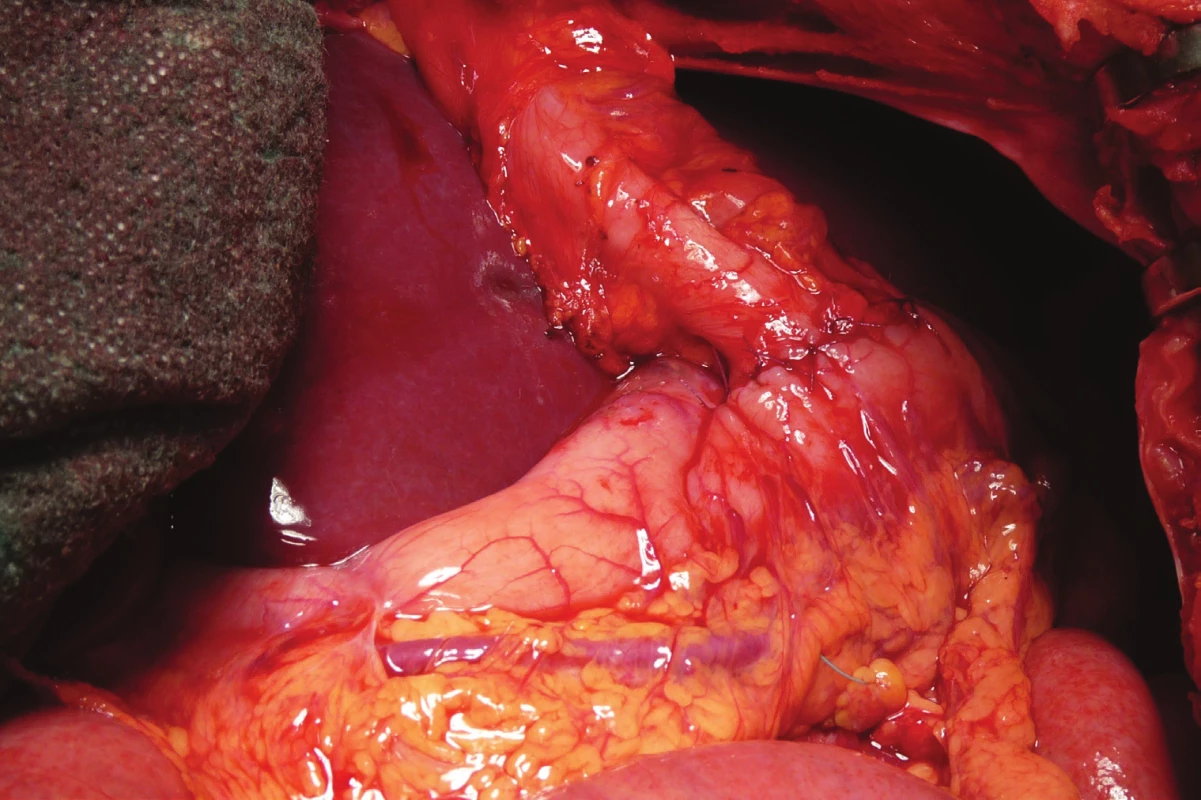 Anastomóza
aborální části kolon
s přední stěnou žaludku<br>
Fig. 7: Anastomosis of the
aboral part of the colon
with the front wall of the
stomach