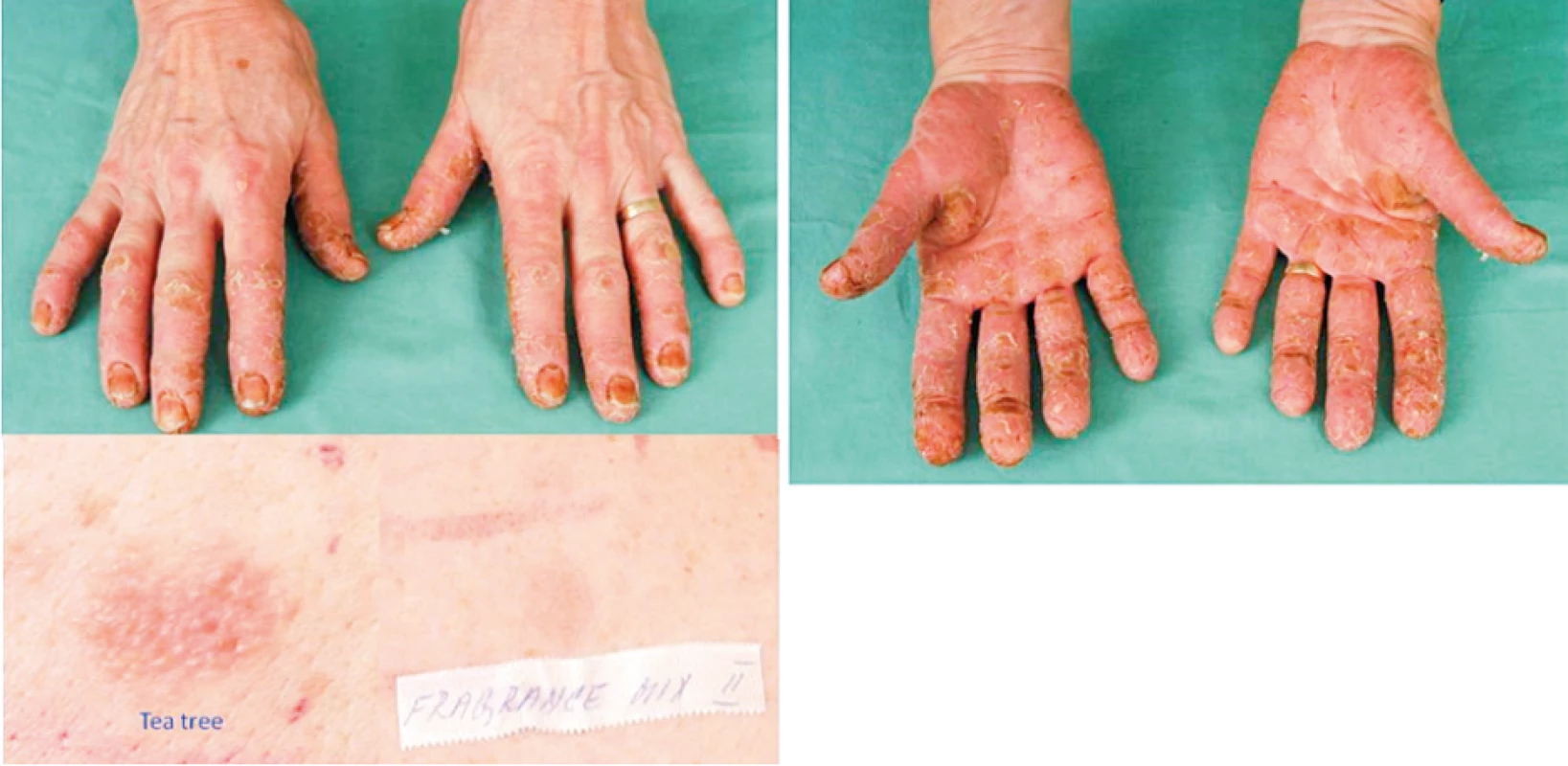 Eczema contactum et atopicum – tea tree+++, fragrance
mix II++ (kosmetické přípravky), kumarin++, ol. Pini++, nikl+++
(bižuterie) – elektrotechnička