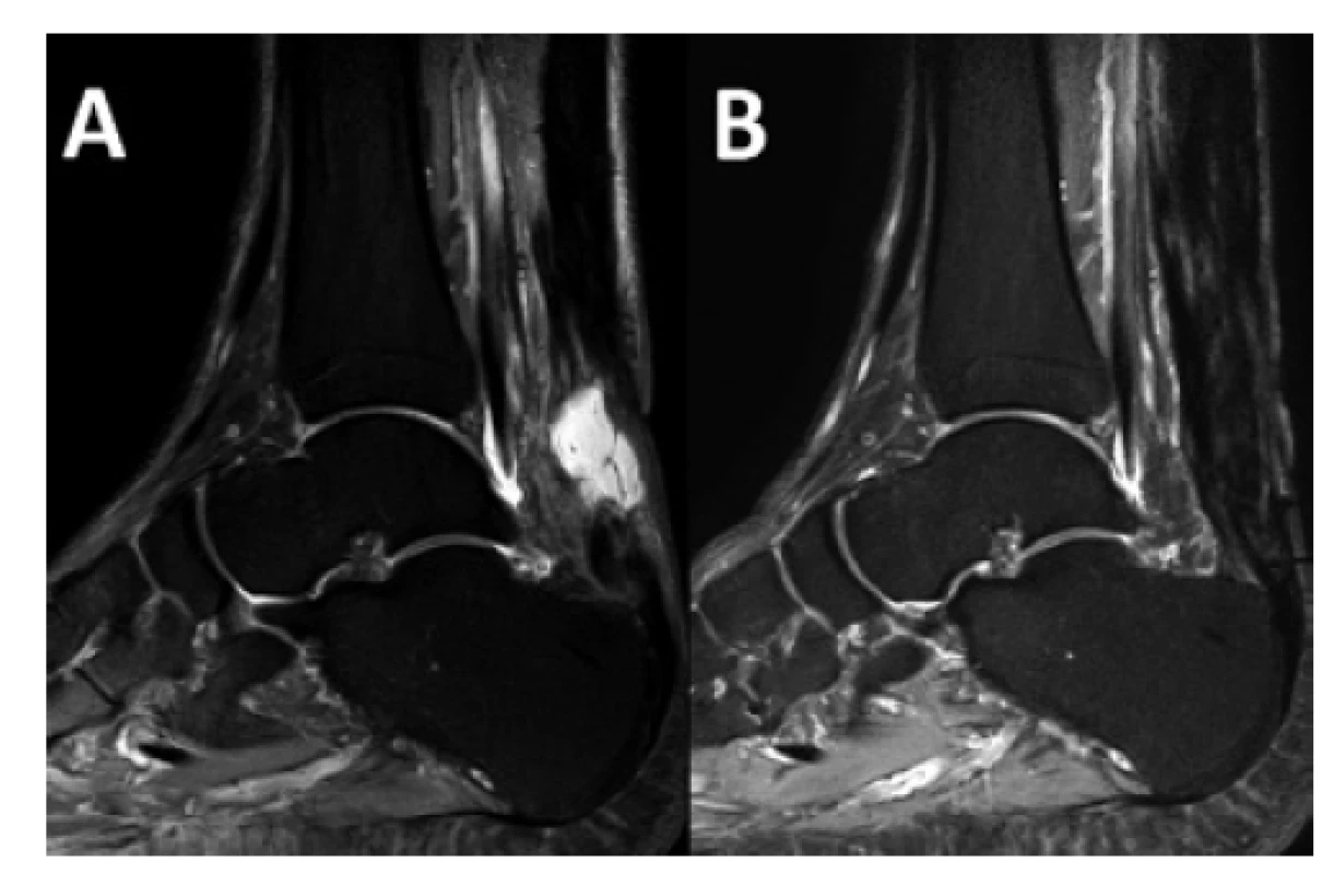 MRI inveterované ruptury Achillovy šlachy v sagitální
rovině<br>
A – Stav před rekonstrukcí s vyzrávajícím hematomem v defektu,
B – stav po plastice s obnovením kontinuity šlachy.<br>
Fig. 1: MRI of chronic Achilles tendon rupture in the sagittal
plane.<br>
A – Condition on presentation with a maturing hematoma
at the defect site; B – condition after tendon reconstruction
with restored tendon continuity.