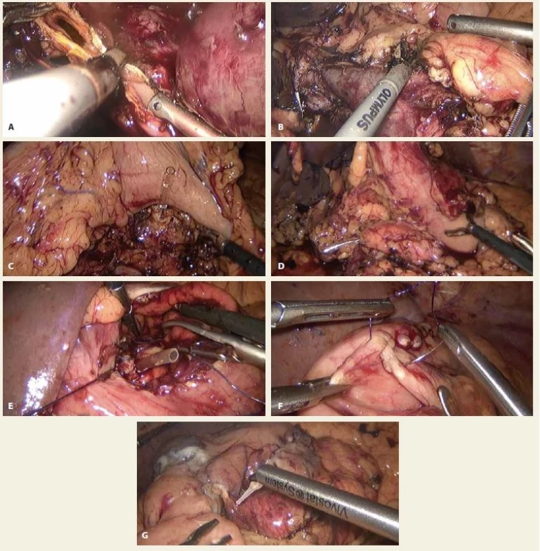 A. Interruption of common dilated hepatic duct, B. interruption of pancreas (in the area of neck) with visible superior
mesenteric vein and confl uence, C, D. posterior gastric wall and remnant of pancreas with inserted stent to the
pancreatic duct, E. suturing of pancreatogastro-anastomosis through anterior gastrotomy, at the bottom remnant of
pancreas with inserted stent to the pancreatic duct, F. suture of the anterior gastrotomy, G. application of autologous
platelet-rich fi brin sealant Vivostat® for anastomosis augmentation.<br>
Obr. 2. A. Přerušení dilatovaného společného jaterního vývodu, B. Přerušení slinivky v místě krčku s patrnou dolní mezenterickou
žílou a konfluens, C, D. zadní stěna žaludku a přerušená slinivka se stentem v pankreatickém vývodu, E. našívání pankretogastro-
anastomózy přes přední gastrotomii, na spodině patrna slinivka se stentem v pankreatickém vývodu, F. sutura přední
gastrotomie, G. aplikace autologního destičkového fibrinem obohaceného lepidla Vivostat® k augmentaci anastomóz.