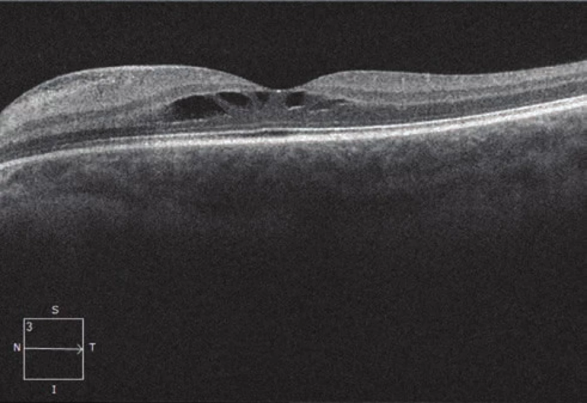 HD-OCT: Linear horizontal transfoveolar scan of
left eye, follow-up examination after 4 months, image of
stationary schisis-like maculopathy