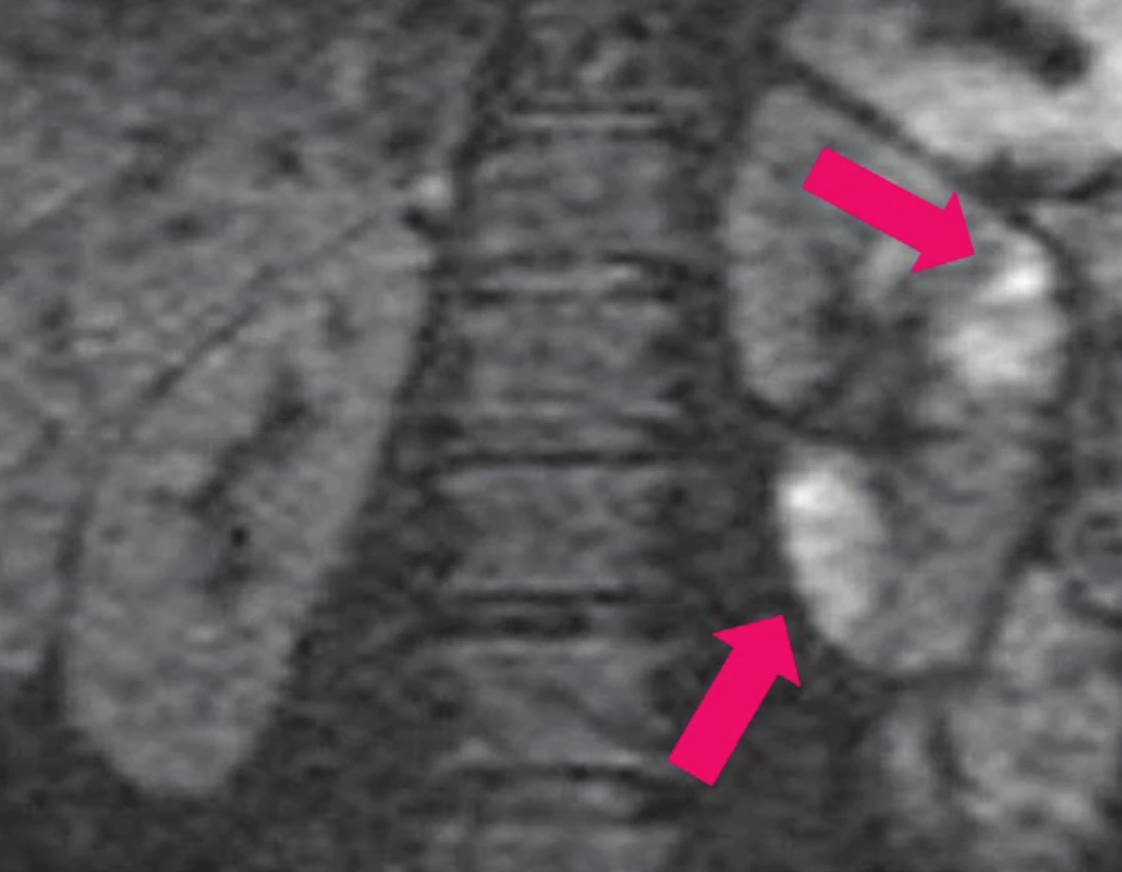 DW-MRI: víceložiskové zánětlivé změny v parenchymu ledviny
v akutní fázi pyelonefritidy (světlé–bílé hypersignální oblasti).