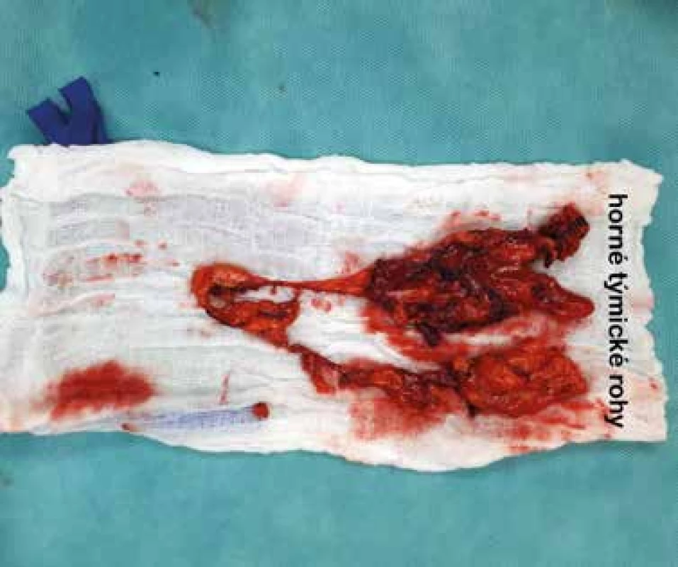 En bloc extrahovaný týmus a peritýmické tkanivo<br>
Fig. 5: En bloc extracted thymus and perithymic tissue