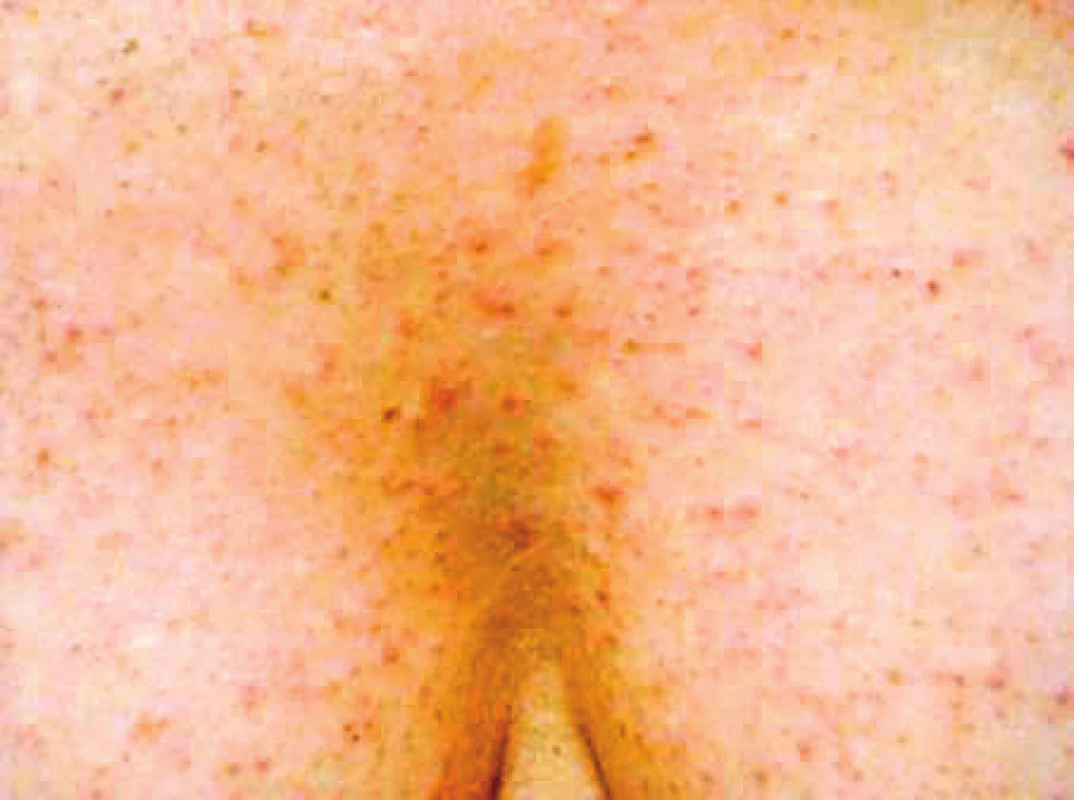 Kožní změny – rash při cílené léčbě