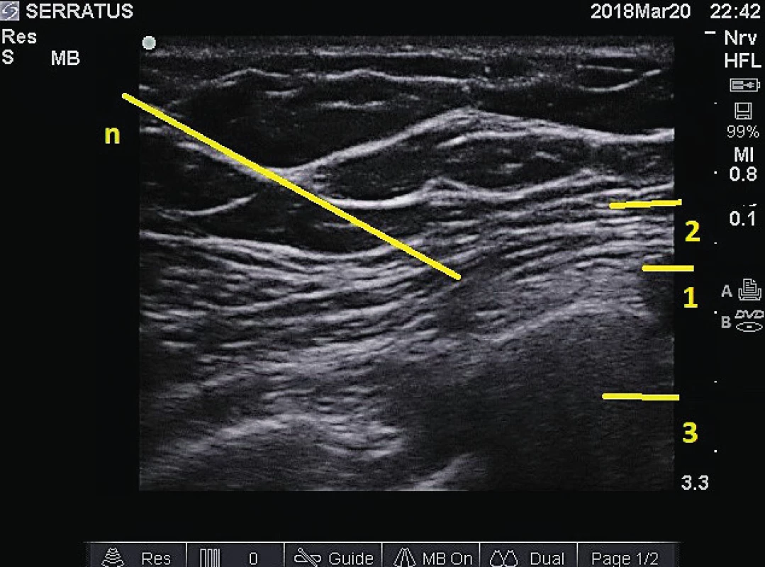 „Serratus plane“ blok. 1 – m. serratus anterior, 2 –
m. latissimus dorsi, 3 – žebro, n – průběh jehly