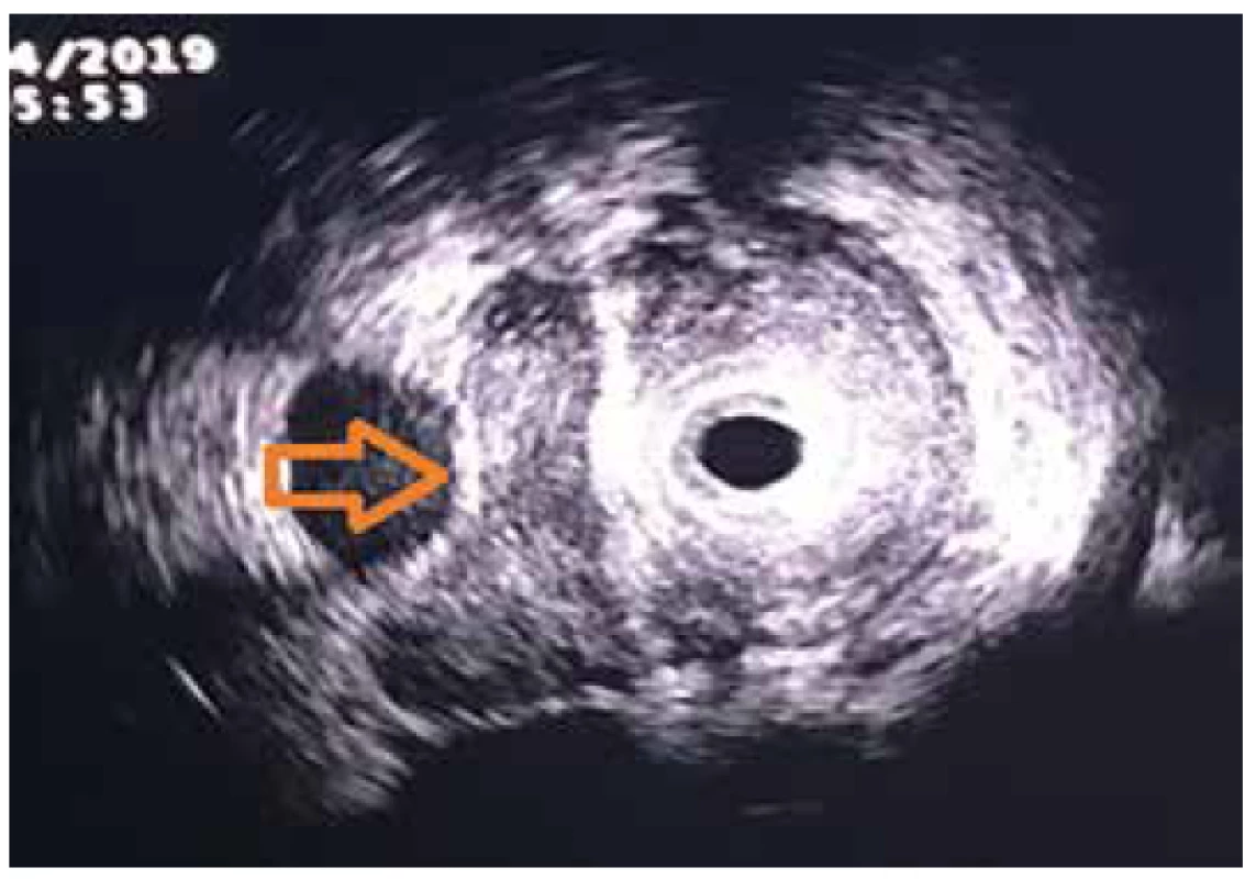 Intraduktální sonografie – ductus choledochus infiltrován
tumorem, portální žíla bez infiltrace, oddělena tenkým
pruhem hyperechogenní tkáně<br>
Fig. 3. Intraductal ultrasonography – common bile duct
infiltrated by the tumour, portal vein without infiltration,
separated by a thin layer of hyperechogenic tissue