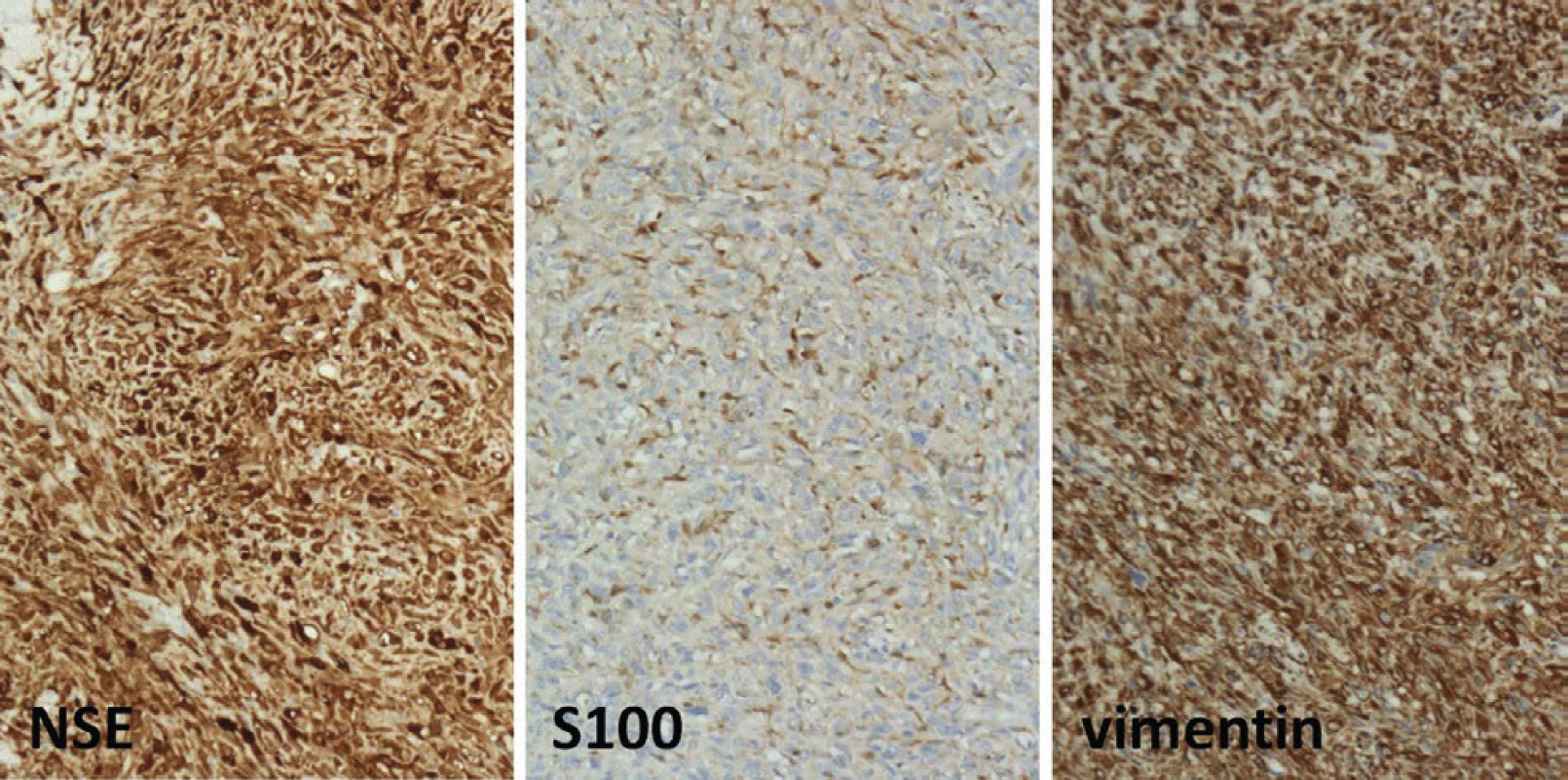 Neurofibroma growing inside eyeball with intensive
neuron-specific enolase (NSE), vimentin and slight expression of protein S100. Haematoxylin and eosin - 100x