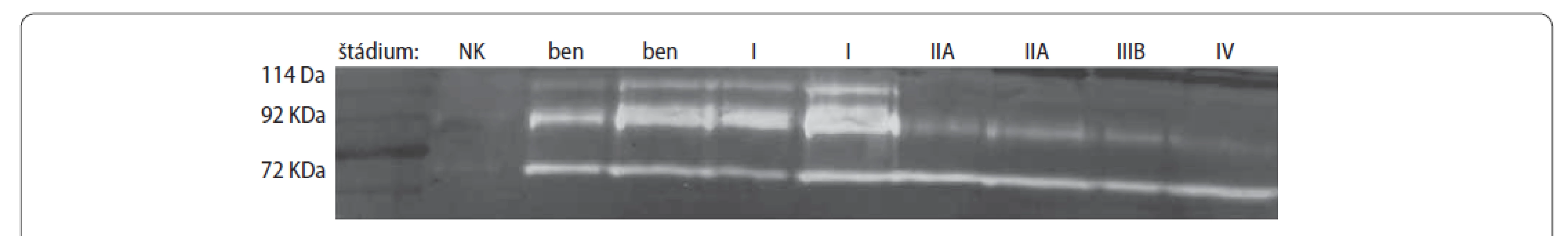 Zymogram séra pacientov s CRC.