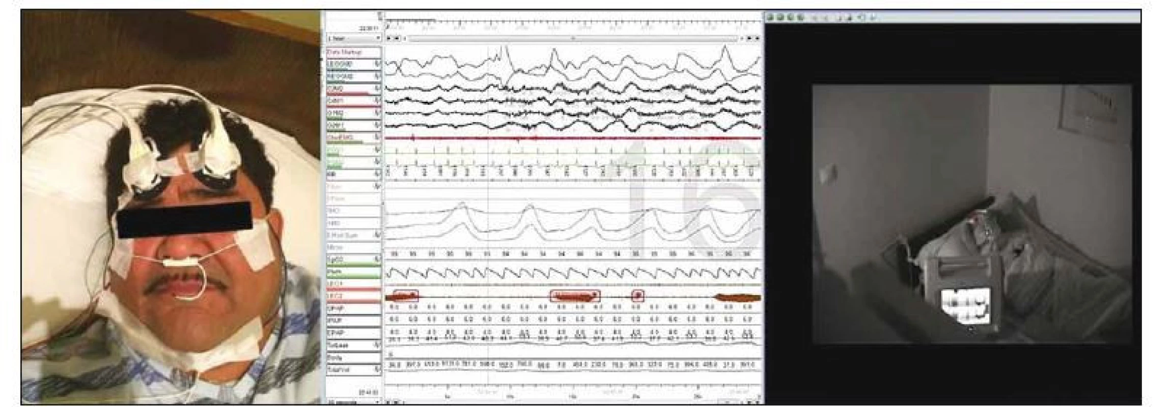 Stanovenie prietoku krvi mozgom pomocou prístroja C-FLOW počas polysomnografie.<br>
Fig. 3. The use of C-FLOW device for the assessment of cerebral blood fl ow during polysomnography.
