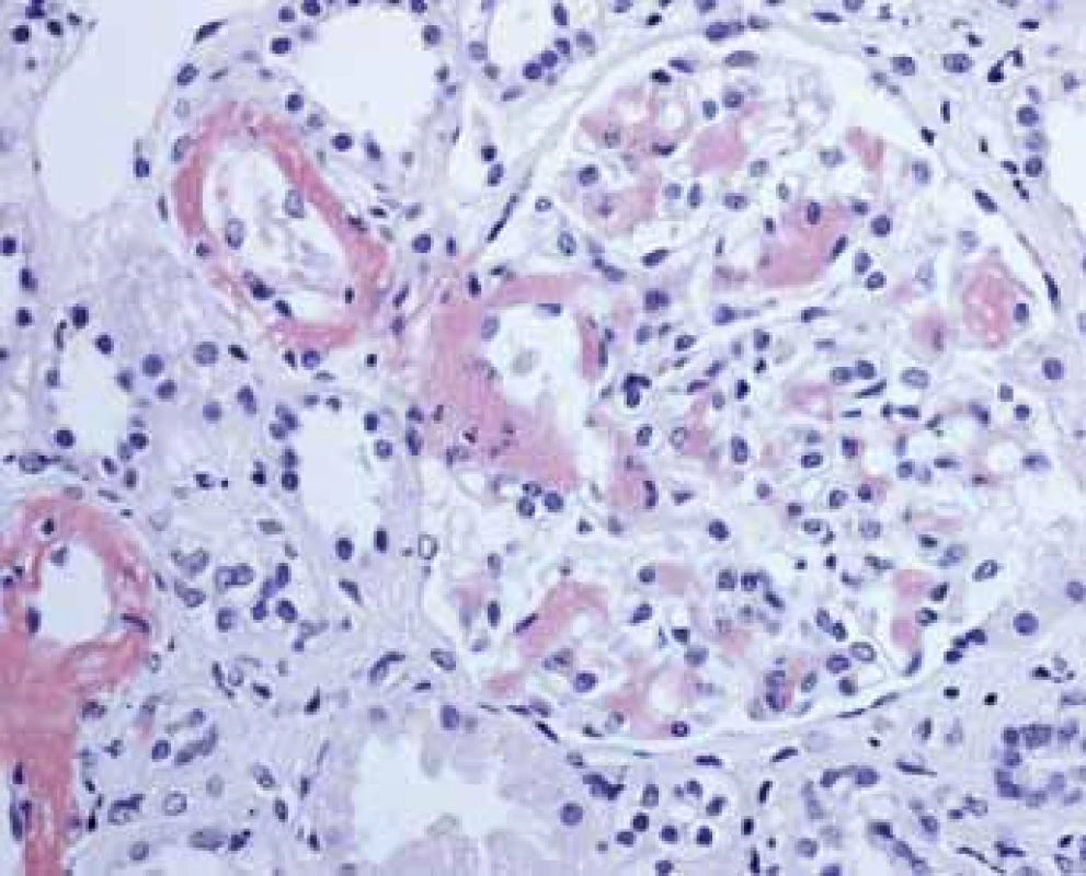 Histologické nálezy u pacientů s IBD a renálním postižením (tubulointersticiální nefritida, glomerulonefritida, AA amyloidóza). Glomerulus s Kongo červeň pozitivními depozity amyloidu.<br>
Fig. 9. Biopsy pictures in IBD patients with renal illness
(tubulointerstitial nephritis, glomerulonephritis, AA amyloidosis). Glomerulus with Kongo red positive
deposits of amyloid.