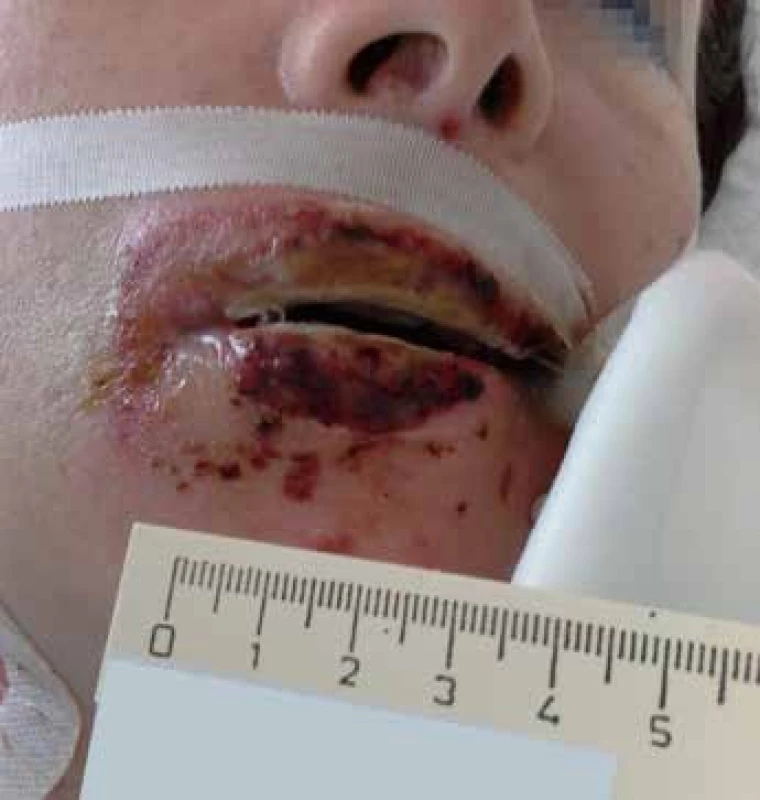 Rty 4. den hospitalizace