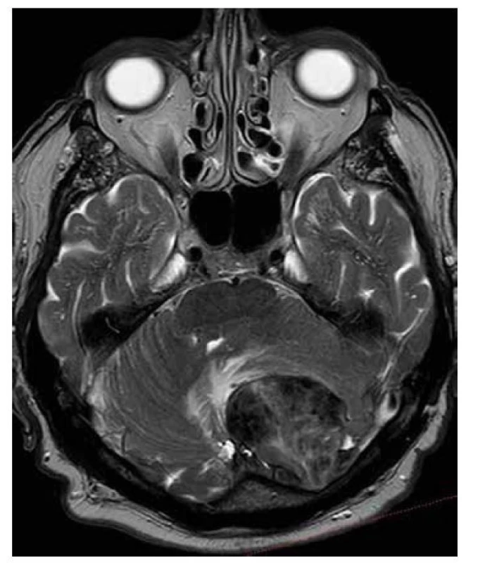 Solitární fibrózní tumor T2W: objemný tumor zadní jámy lební, nízkých
intenzit v T2W čase, s nehomogenitami signálu v susceptibilním vážení,
svědčící pro fibrozní charakter tkáně s přítomností kalcifikací, s menším
perilezionálním edémem a kompresí IV. komory, s infiltrací kalvy.