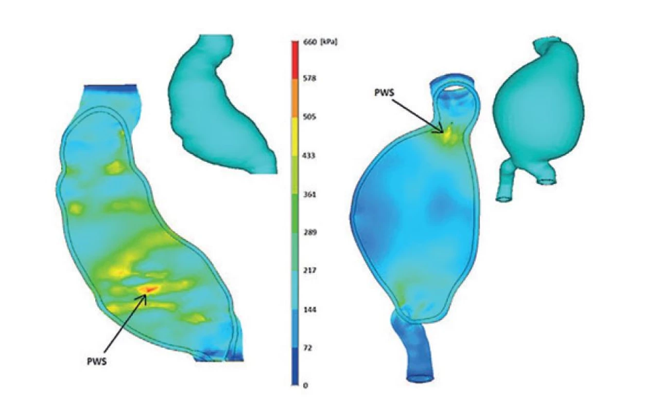 Napětí cévní stěny rizikového a bezpečného AAA<br>
Fig. 5: Vascular wall stress of risk and safe AAA
