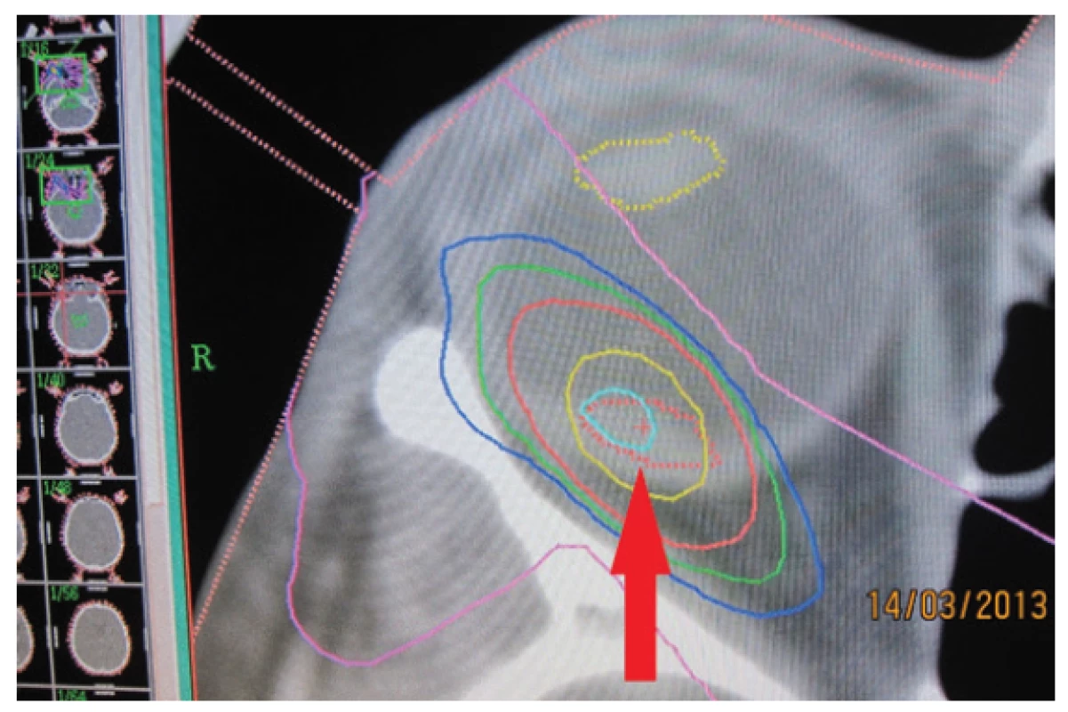Stereotactic plan of irradiation of deposit in 2013