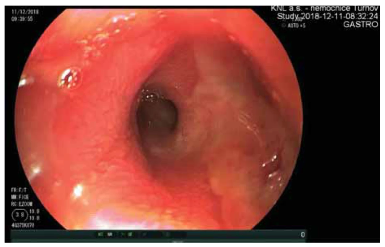Iniciální endoskopický nález exulcerované sliznice proximálního jejuna.<br>
Fig. 1. Initial endoscopic finding of exulcerated mucosa of the proximal jejunum.