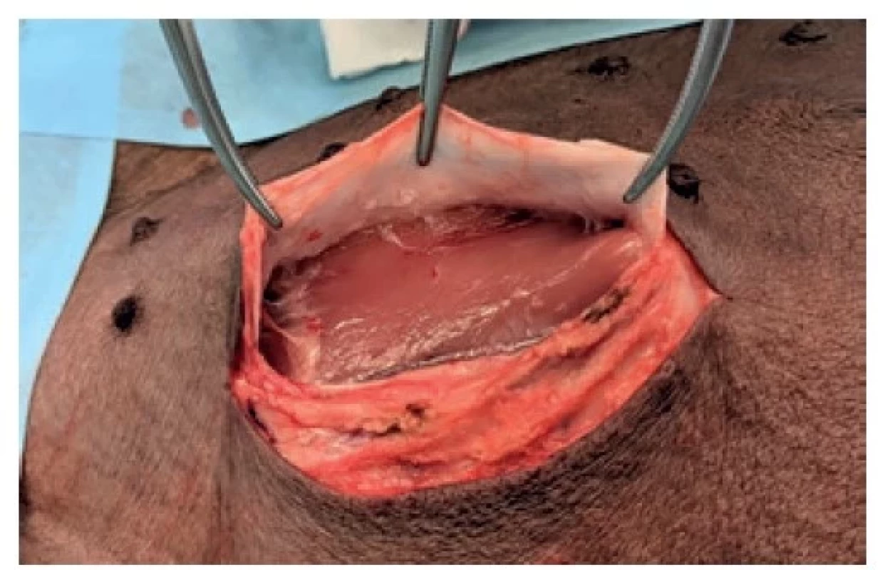 Incize, odhalený musculus rectus sinister<br>
Fig. 2: The incision; exposed left rectus muscle