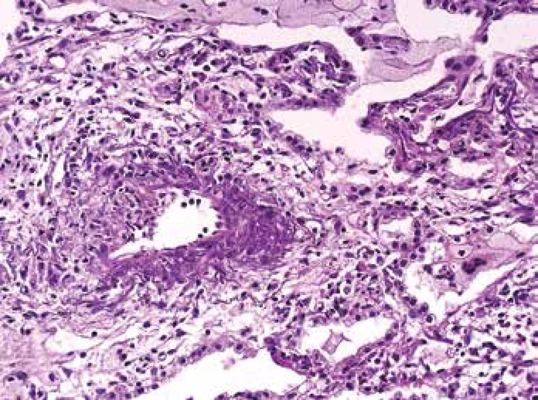 <b>Biopsie plic s vaskulitidou</b>, se segmentální destrukcí cévní stěny, se zánětem v postiženém úseku cévní stěny i v okolí (barvení HE s elastikou).