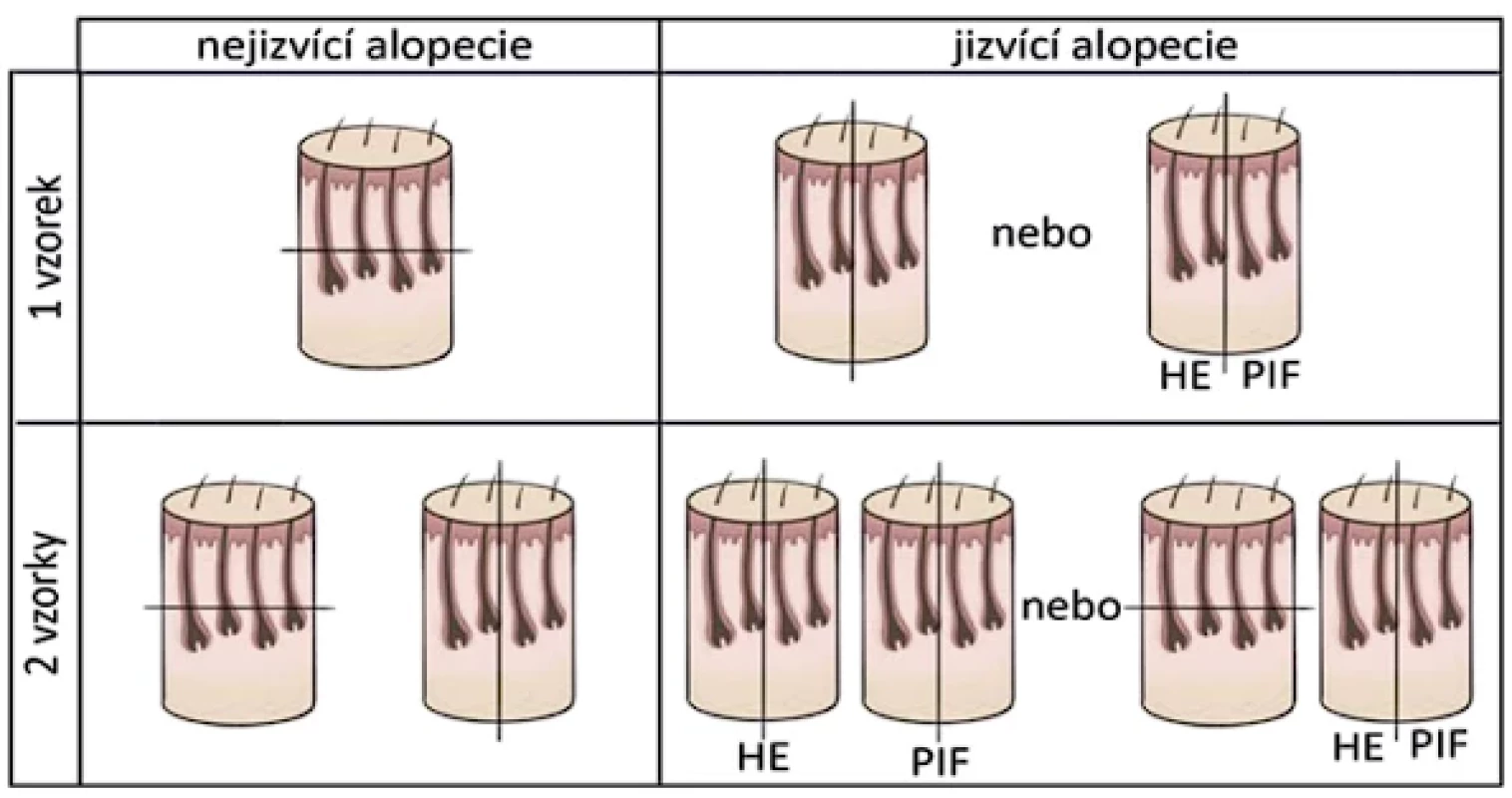  Návrh doporučeného zpracování bioptického materiálu u alopecií (adaptováno dle [18]). PIF – přímá imunofluorescence