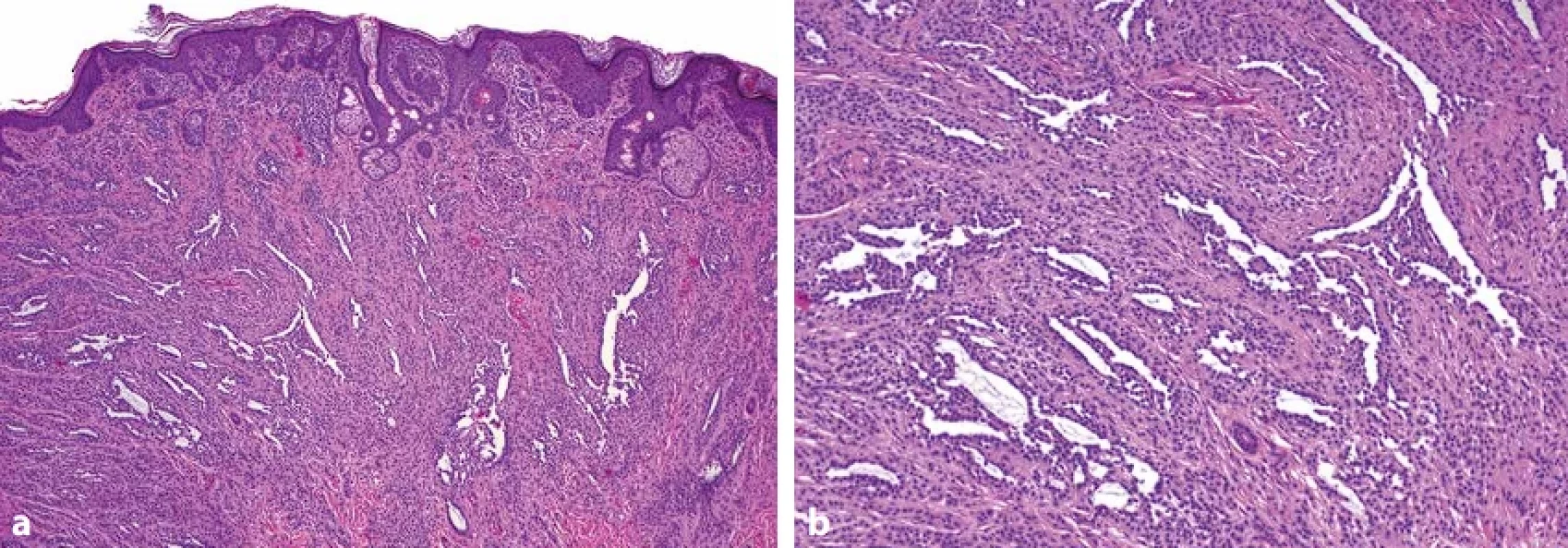  P a, b. Pseudovaskulární prostory u smíšeného melanocytárního névu (HE, původní zvětšení 40x, 100x).