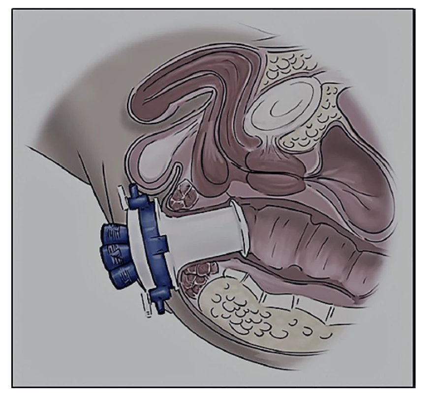 Flexibilní single port platforma Gelpoint (Applied
Medical, USA)<br>
Fig. 1: Flexible single port platform Gelpoint (Applied Medical,
USA)