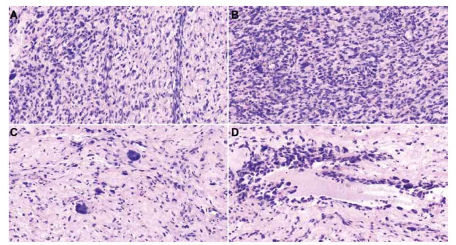 histologické preparáty barvené hematoxylinem-eosinem zobrazující vřetenobuněčný tumor s kolagenním a částečně myxoidním stromatem
a s kolísající celularitou (A, 40x). V hypercelulárních úsecích jsou patrné paralelně uspořádané blandní bazofilní vřetenité buňky vzhledu fibroblastů
(B, 40x). Fokálně nacházíme obrovské vícejaderné buňky s věnčitě uspořádanými jádry, tzv. “floret-cells” (C, 40x). Ve stromatu jsou místy
pseudovaskulární prostory lemované obrovskými buňkami a pleomorfními vřetenitými buňkami s hyperchromními jádry (D, 20x).