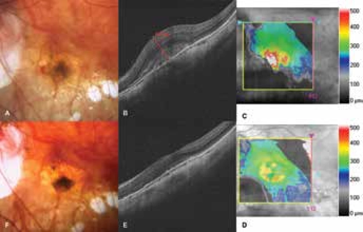 Choroidal neovascularisation in a patient with pathological myopia<br>
A. Photograph of fundus before commencement of treatment with ranibizumab. Lesion on neovascular membrane, in nasal
part subretinal haemorrhage<br>
B-C. HD-OCT before treatment. Hyperreflective tissue, through-growing retinal pigment epithelium. Edema of neuroretina
with central retinal thickness of 675 μm<br>
D-E. HD-OCT after treatment. Reduction of edema, indication of foveolar depression<br>
F. Photograph of fundus after treatment. Lesion bordered, haemorrhages absent