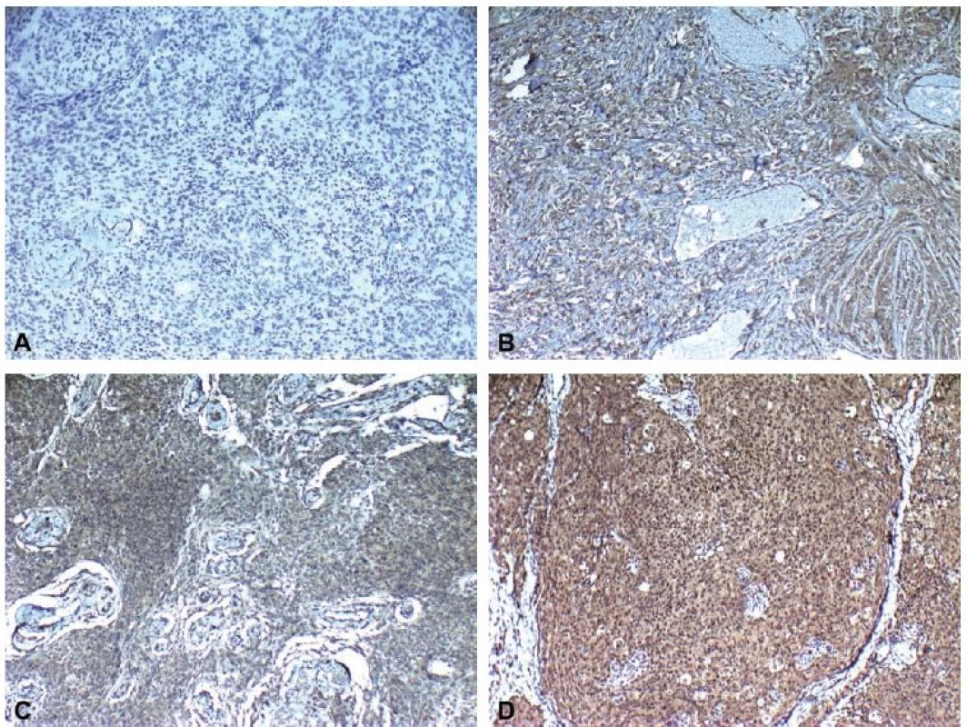  mmunohistochemical staining scores showing A) none (0), B) weak (1), C) moderate (2) and D) intense (3) immunoreactivity (leptin ×100).<br>
Obr. 2. Imunohistochemické skóre zabarvení ukazující A) žádné (0), B) slabé (1), C) střední (2) a D) intenzivní (3) imunoreaktivitu (leptin × 100).
