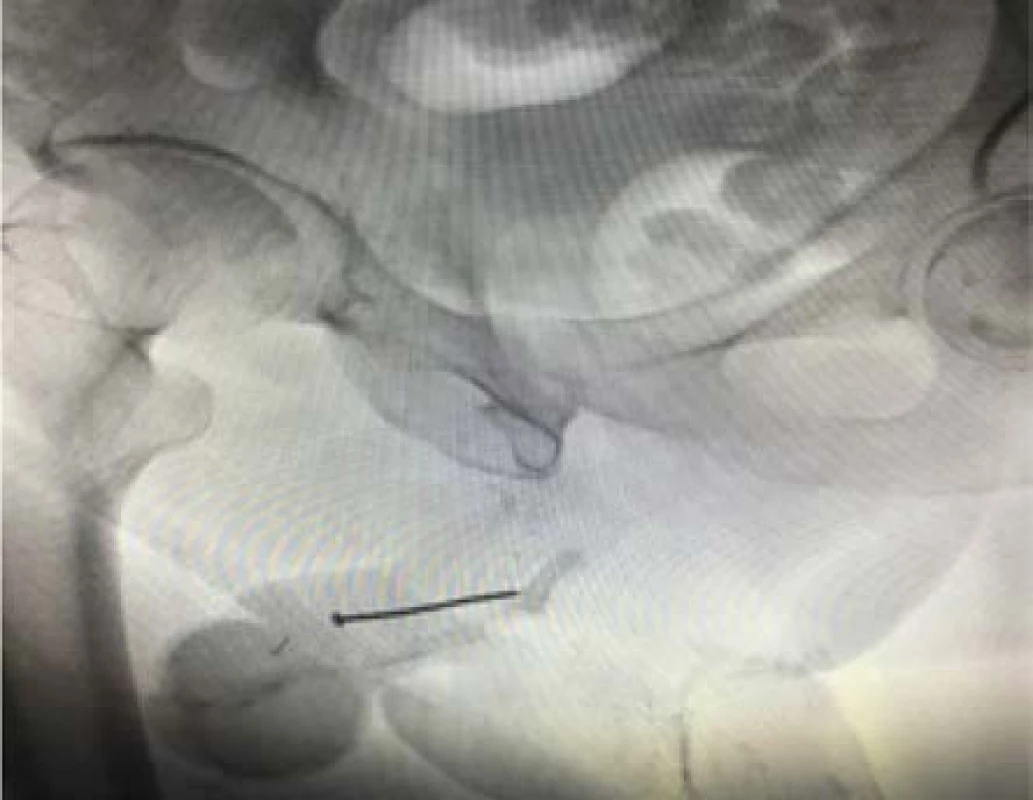Cizí materiál v penisu, není souvislost s močovou
trubicí (z archivu Kliniky radiologie a nukleární
medicíny, Fakultní nemocnice Brno)<br>
Fig. 2. Foreign material in the penis, not associated
with the urethra (from the archives of the Clinic of Radiology
and Nuclear Medicine, University Hospital Brno)